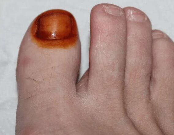 Fungal iodine treatment