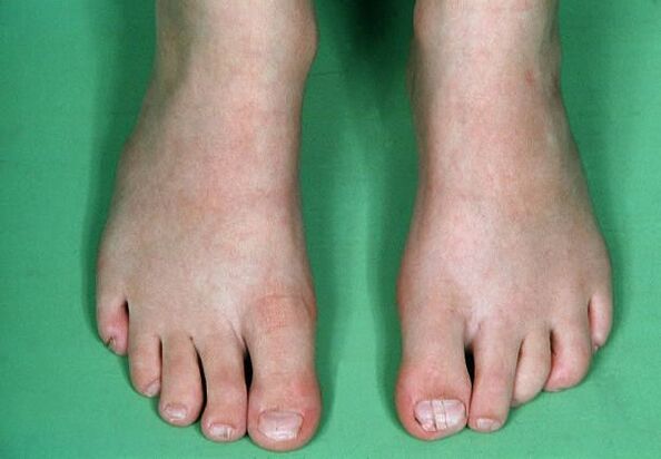 The fungus on the legs