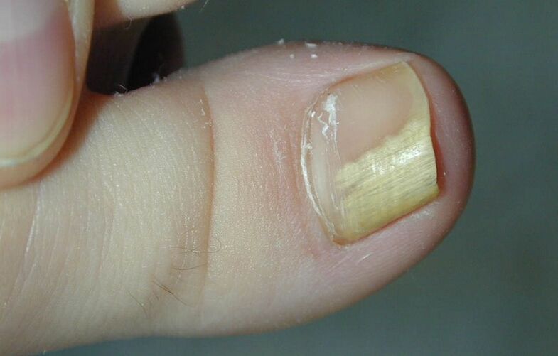 toe nail fungus