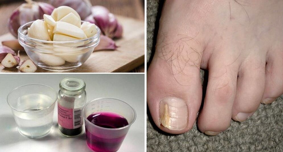 garlic and potassium permanganate for nail fungus