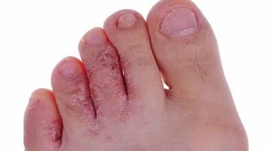 Types and steps in the development of fungi on the legs