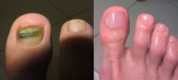 Treatment of nail fungi