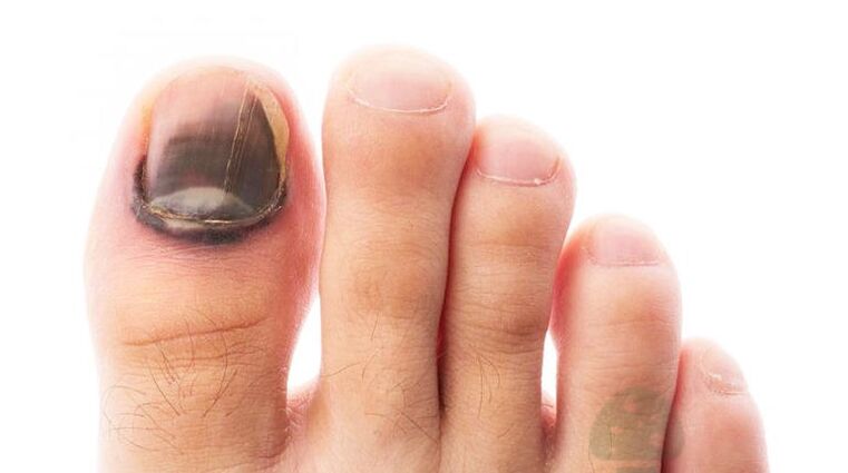 The disease stadium of the disease with a fungus of the thumb nail