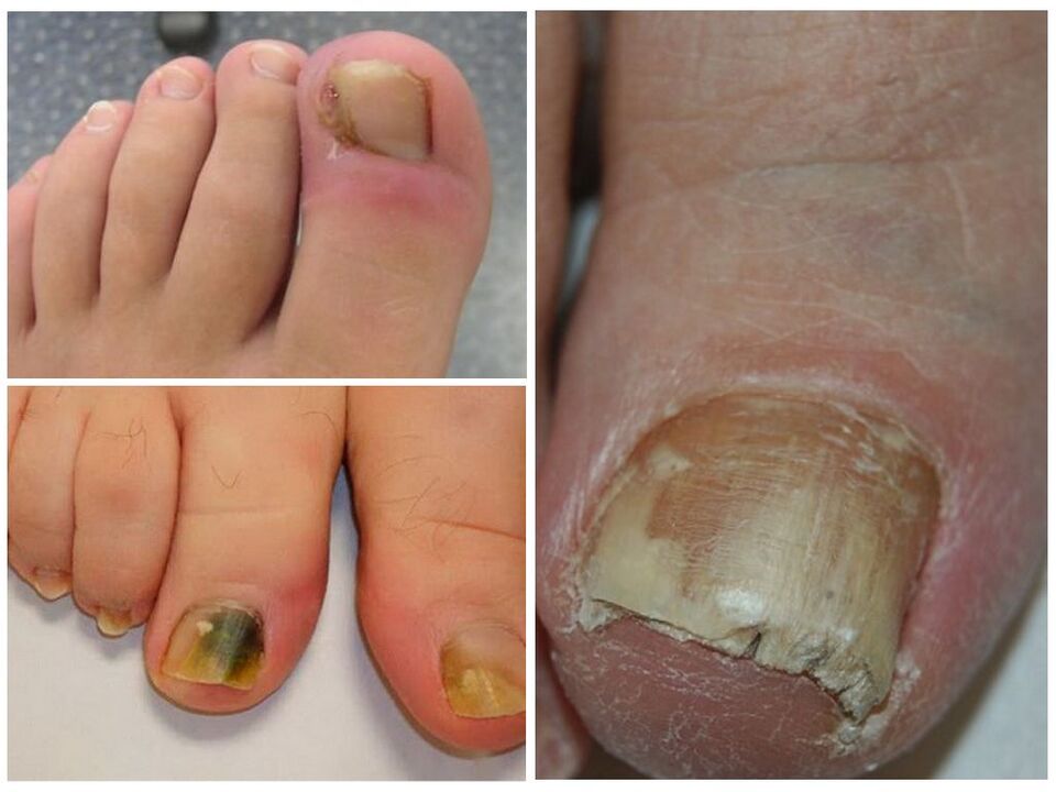 fungal infection of toenails