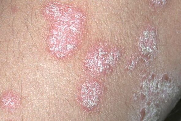 Psoriasis caused by fungal infection