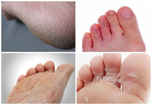 The main manifestations of foot fungus are keratinization of the skin, cracks, and peeling.