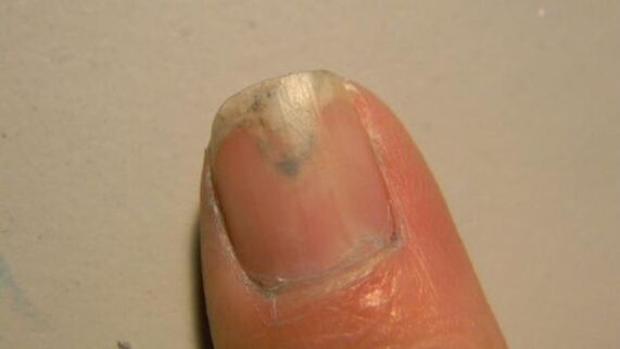nail fungus symptoms