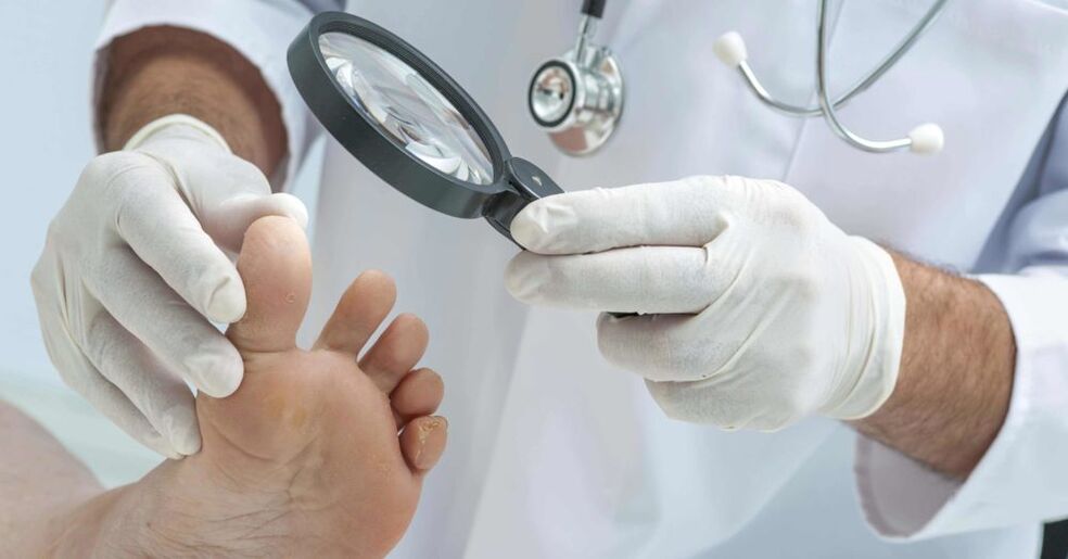 the doctor examines the feet for fungus