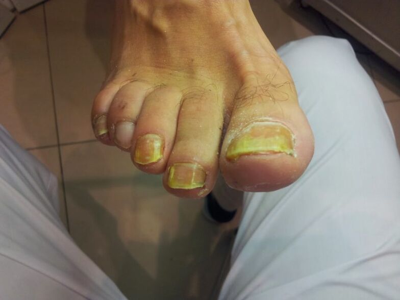 yellow nails due to fungus