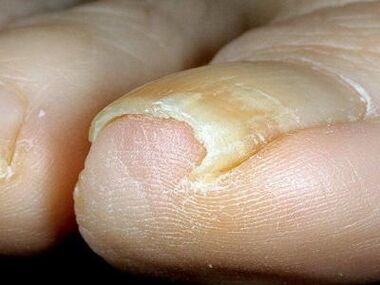 Appearance of nails infected by fungus